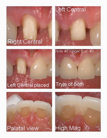 Insertion of veneers pg 2_resize_resize.jpg